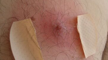 duvidas sobre furunculos