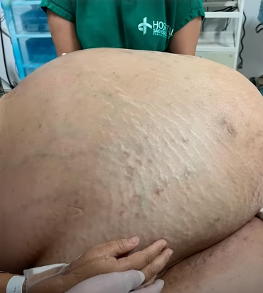 tumor de 46 kg