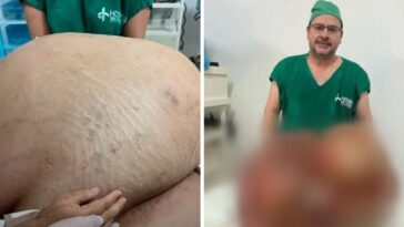 tumor de 46 kg