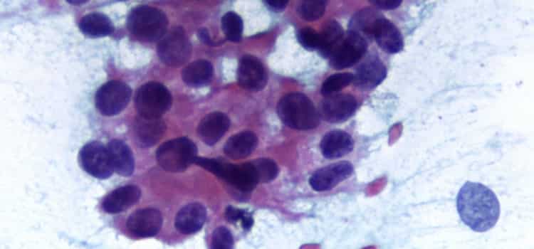 tumor em tecido epitelial