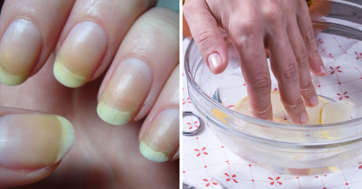 Unhas amareladas? Veja essas dicas de como clarear