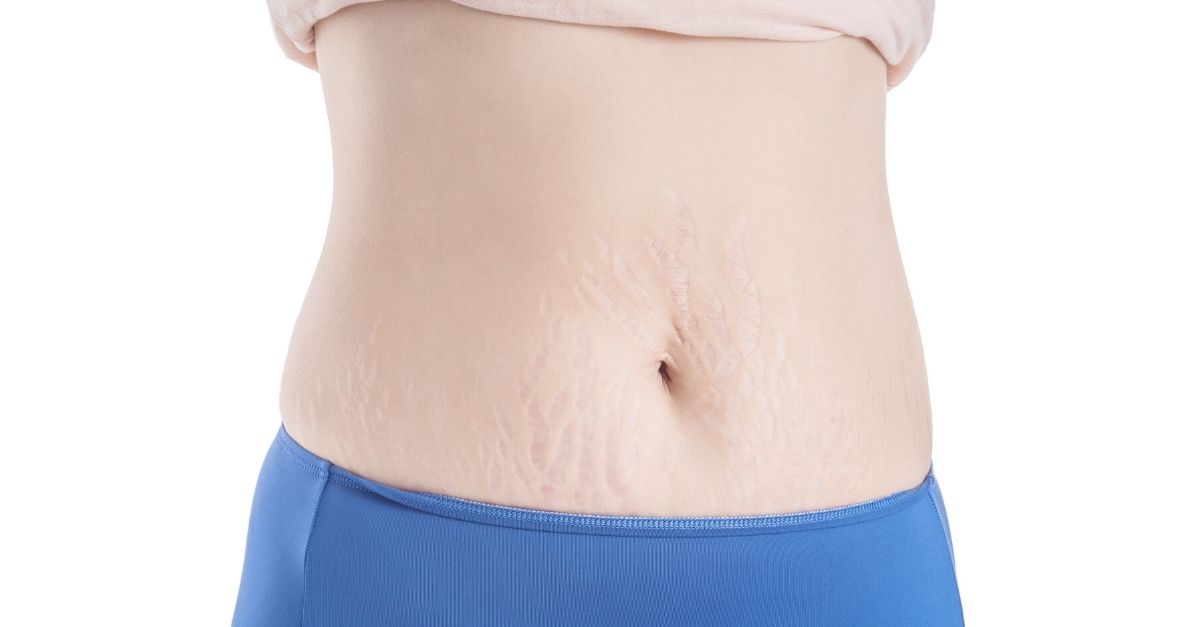 cicatricure para estrias