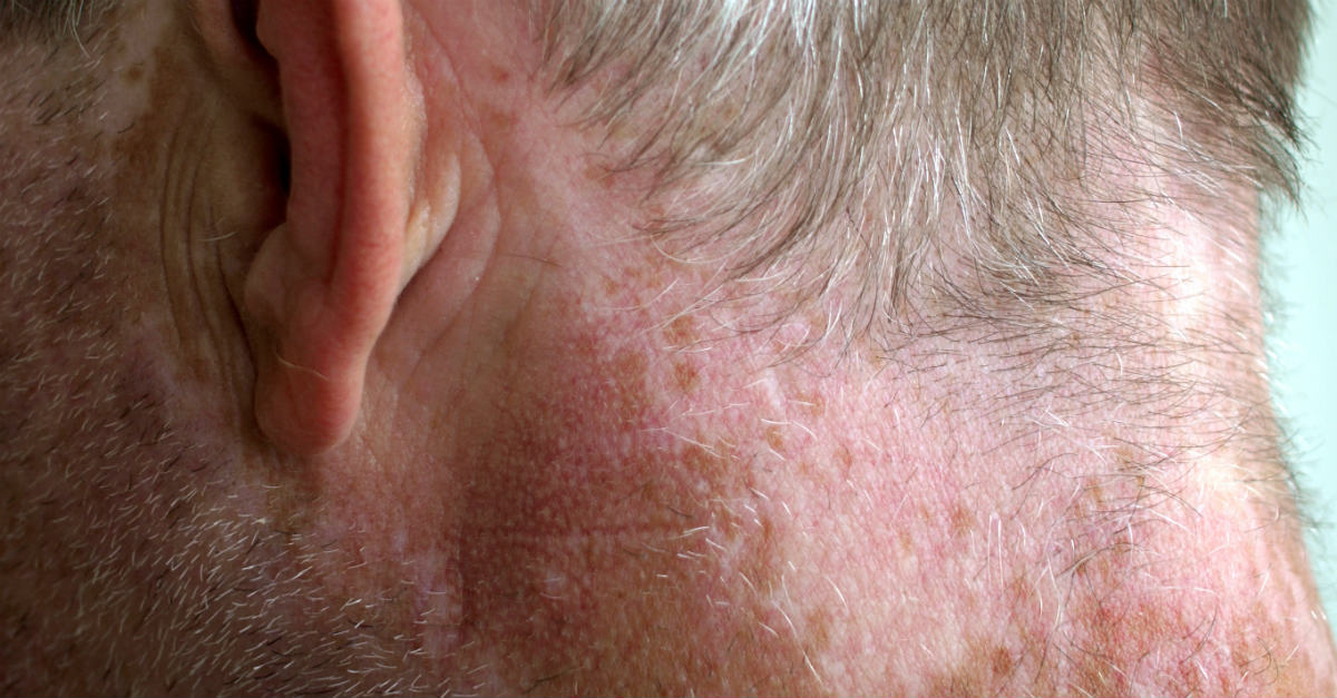 vitiligo tratamento disponível